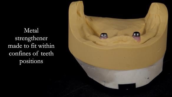 Newsletter 57 showcases the making and fitting process of implant-supported complete dentures for Alisdair