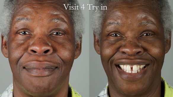 Newsletter 53 showing the making and fitting of ultra life-like dentures for Valena