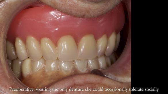 Newsletter 83: Sheila’s Complete Denture Success