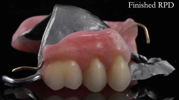 Finlay's Newsletter 60 Sylvia's upper Kennedy Class 2 Mod 1 metal based upper RPD