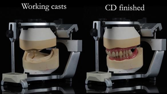 Finlay's Newsletter 62 provision of extractions and metal based complete dentures for Rafique
