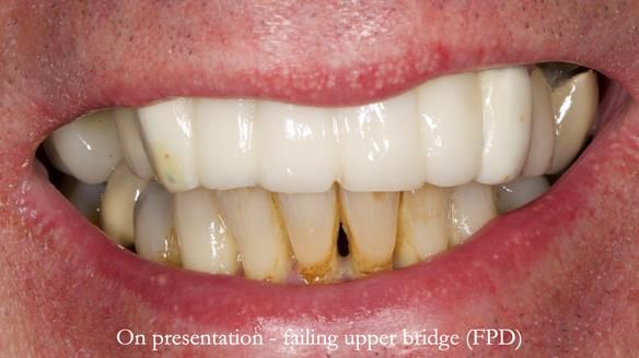 Newsletter 77: Jeremy’s case – immediate complete upper denture