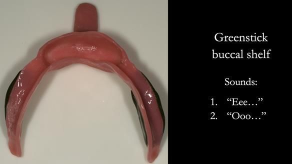 Greenstick right and left buccal shelves from canine to second molar position – avoid the retromolar pad – this is moulded in the patients mouth by the patient saying “EEE” and “OOO” with exaggerated cheek movements.