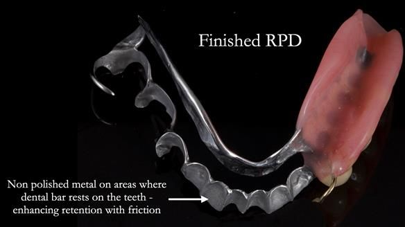 Finlay's Newsletter 61 provision of a lower unilateral free end saddle metal based partial denture for Joyce