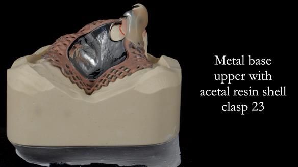 Newsletter 55 Provision of metal based partial dentures for Zephyrine with a repaired cleft lip and palate