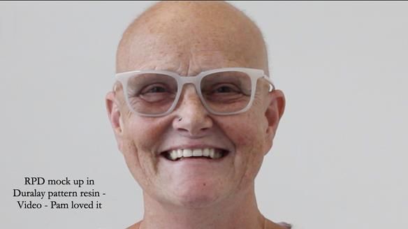 Newsletter 81 - Pam’s Story — how a partial denture changed her life (+ live walkthrough this Thursday)