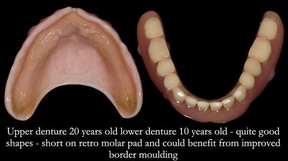 Newsletter 75: Marion’s case - Step-by-step complete denture workflow