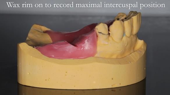 Newsletter 56 showing the making and fitting of a bilateral free end saddle upper removable partial denture (RPD) for patient with pemphigus