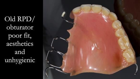 Upper metal base partial denture/occlusal stabilisation splint/obturator - full protocol
