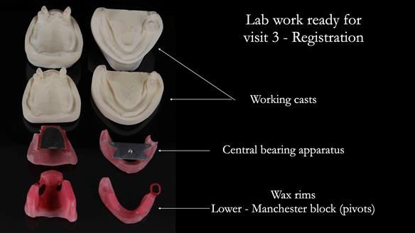 Finlay's Newsletter 59 Ultra hard partial dentures made for Gill