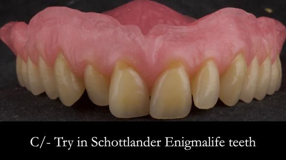 Complete denture Class II div 2 deep overbite Newsletter 39
