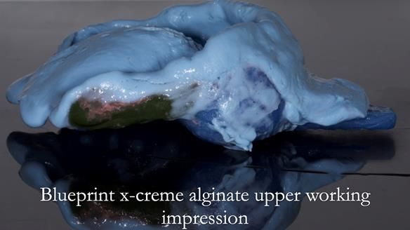 Finlay's Newsletter 64 case study - provision of a Kennedy class 2 metal based Scandinavian RPD for Ian