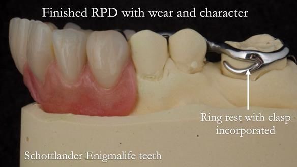 Eileen's transformation with upper and lower RPDs of Scandinavian hygienic design FULL PROTOCOL