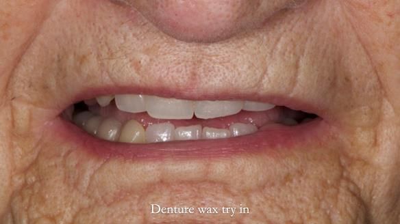 Newsletter 83: Sheila’s Complete Denture Success