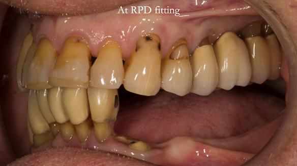 Ken – going downhill, first class