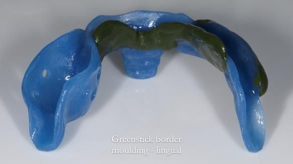 Newsletter 82 Mary - A complete upper and a one-tooth gasket denture