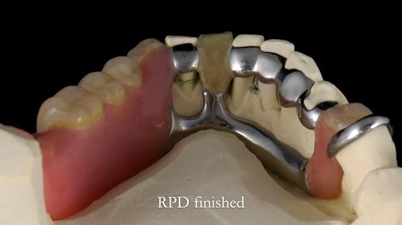 Newsletter 55 Provision of metal based partial dentures for Zephyrine with a repaired cleft lip and palate