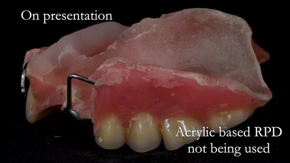 Newsletter 55 Provision of metal based partial dentures for Zephyrine with a repaired cleft lip and palate