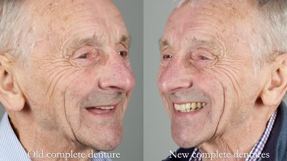 Newsletter 80 - Gordon’s dentures: the one case in 1,000 where my technique failed