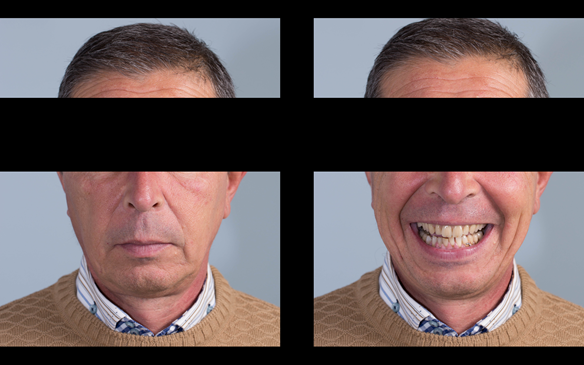 Figure 61 5 months post fitting of Mk 1 immediate dentures