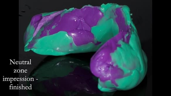 Newsletter 83: Sheila’s Complete Denture Success