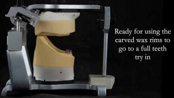 Rowan then uses the carved wax rims to set up the teeth. Notice the Class III skeletal arrangement