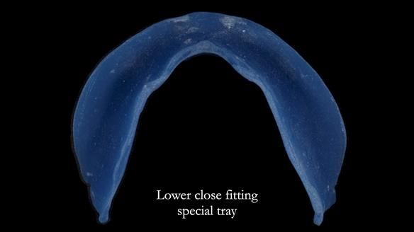 Newsletter 83: Sheila’s Complete Denture Success