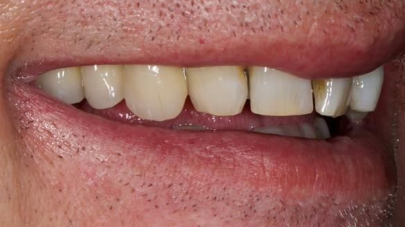 Newsletter 86 Peter the Architect — precision removable partial dentures case study