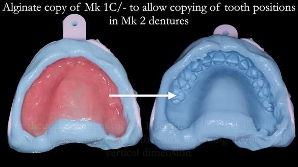 Newsletter 52 Managing Jo’s failing dentition with extractions and Mk 1/Mk 2 complete upper dentures and lower partial dentures FULL PROTOCOL
