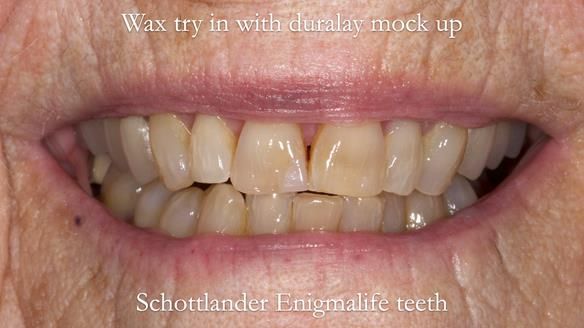 Finlay's Newsletter 60 Sylvia's upper Kennedy Class 2 Mod 1 metal based upper RPD