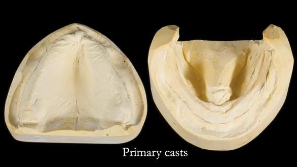 Newsletter 80 - Gordon’s dentures: the one case in 1,000 where my technique failed
