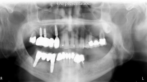 Ken – going downhill, first class