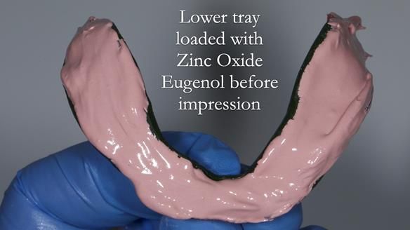 Complete denture Class II div 2 deep overbite Newsletter 39