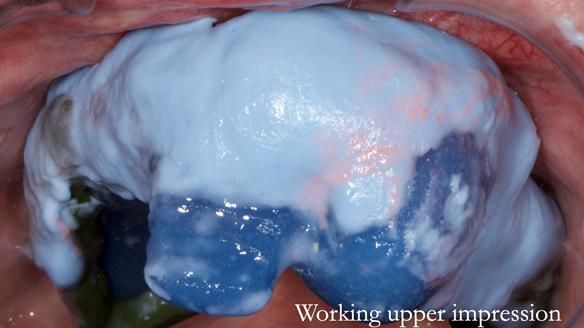 Newsletter 55 Provision of metal based partial dentures for Zephyrine with a repaired cleft lip and palate