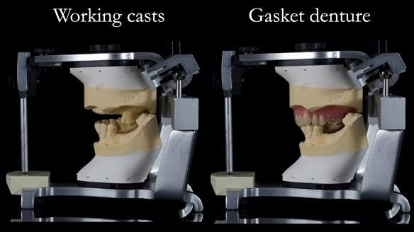 Finlay's Newsletter 58 Gasket upper partial denture for Zoe