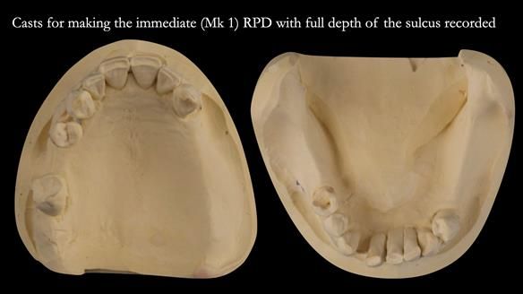 Finlay's Case Study Newsletter 40 - Immediate Mk 1 RPD to Definitive Mk 2 RPD - full protocol