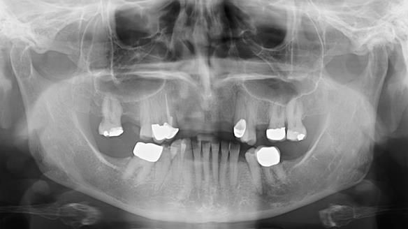 Newsletter 81 - Pam’s Story — how a partial denture changed her life (+ live walkthrough this Thursday)