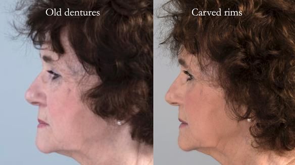 Newsletter 75: Marion’s case - Step-by-step complete denture workflow