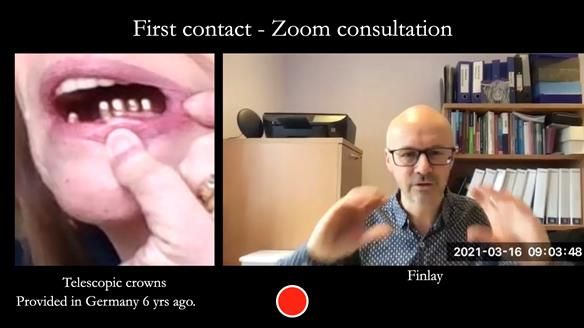 Newsletter 76: Jackie’s case – Telescopic overdenture & precision RPD (the tricky truth!)