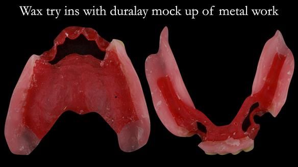 Finlay's Case Study Newsletter 40 - Immediate Mk 1 RPD to Definitive Mk 2 RPD - full protocol
