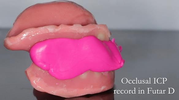 Finlay's Newsletter 62 provision of extractions and metal based complete dentures for Rafique