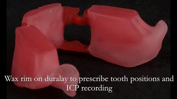Finlay's Case Study Newsletter 40 - Immediate Mk 1 RPD to Definitive Mk 2 RPD - full protocol