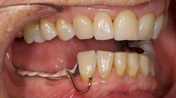 Finlay's Newsletter 61 provision of a lower unilateral free end saddle metal based partial denture for Joyce