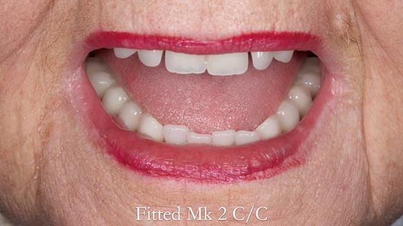 Replacing Madeline’s Complete denture FULL PROTOCOL