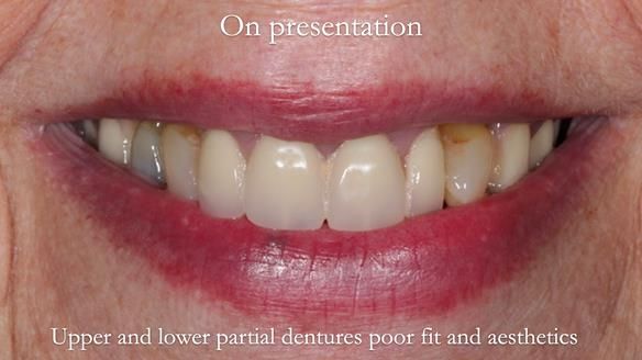 Finlay's Newsletter 59 Ultra hard partial dentures made for Gill