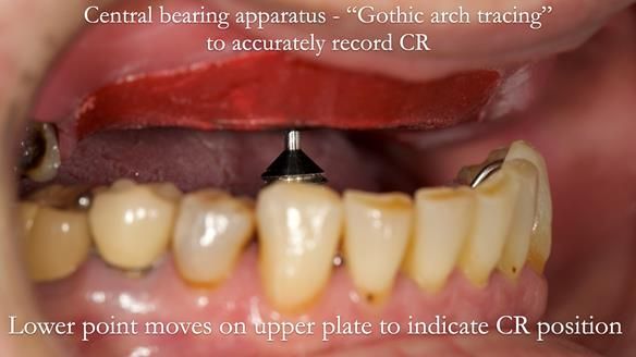 Newsletter 52 Managing Jo’s failing dentition with extractions and Mk 1/Mk 2 complete upper dentures and lower partial dentures FULL PROTOCOL