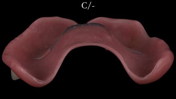 Newsletter 53 showing the making and fitting of ultra life-like dentures for Valena