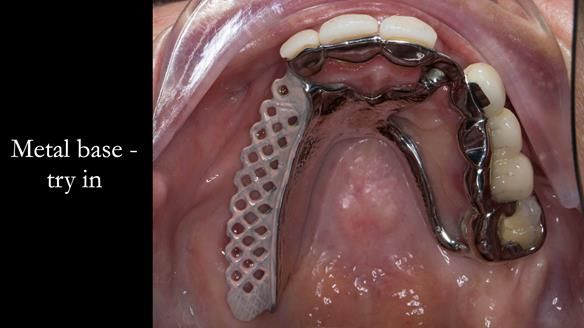 Newsletter 51 Managing Anne’s failing dentition with distal extension base RPD/Splint FULL PROTOCOL
