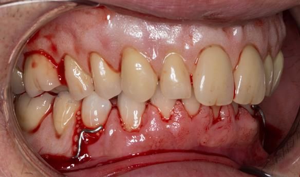 Figure 46 Visit 2 fitting of Mk 1 upper complete and lower partial immediate dentures