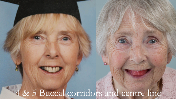 Figure 72 The buccal corridors created by carving back the buccal walls of the rim with reference to the dentate photographs. The centre line is scribed clearly on the rim